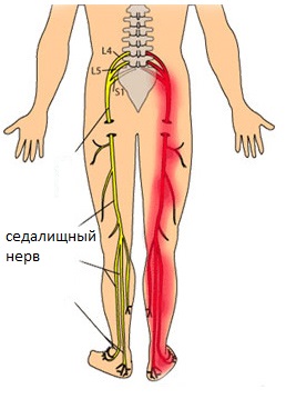 vospalenie-sedalishnogo-nerva-simptomy-i-lechenie.jpg